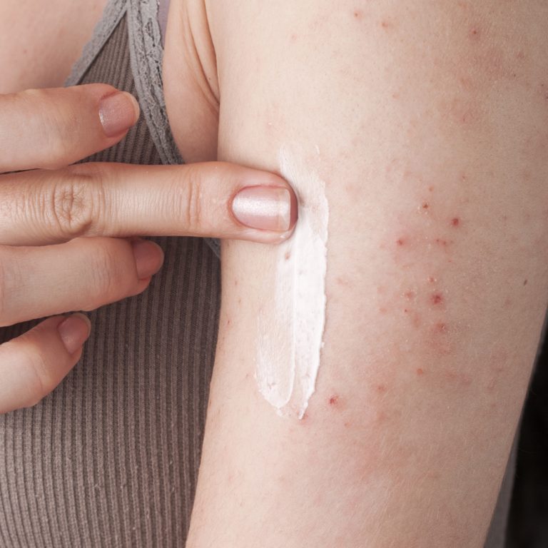 Looking for Some Psoriasis Information or Treatment Discounts?